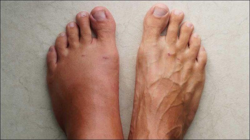 Phù nề chi dưới