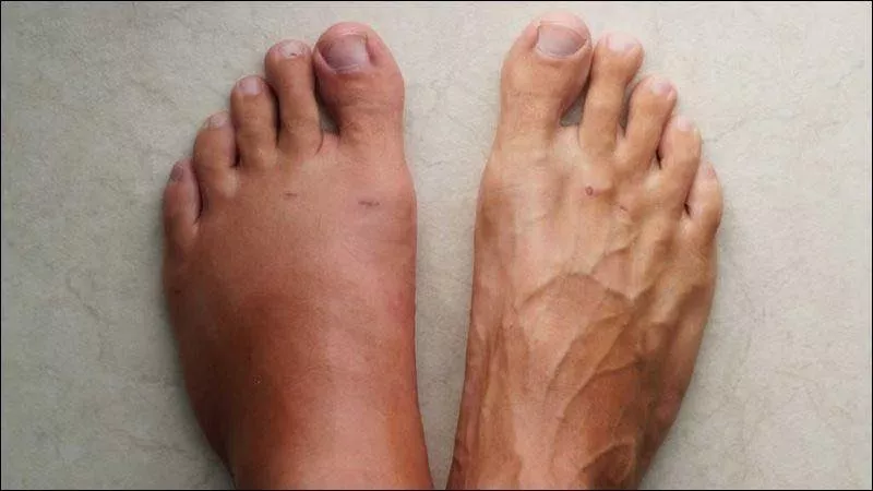 Phù nề chi dưới