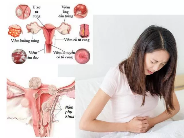 Điều trị bệnh phụ khoa
