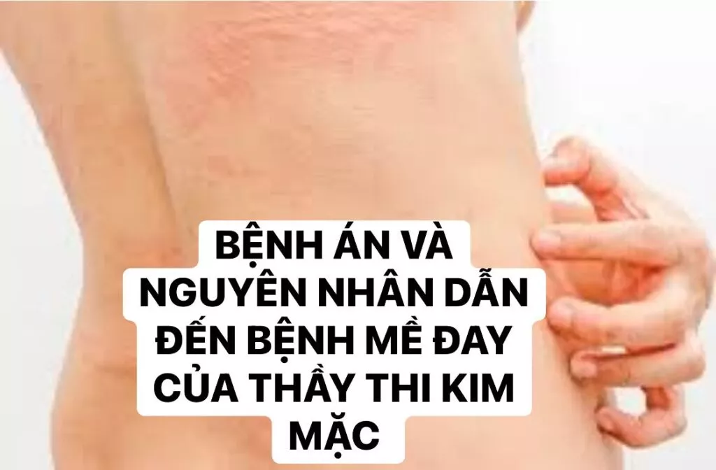 Bệnh mề đay