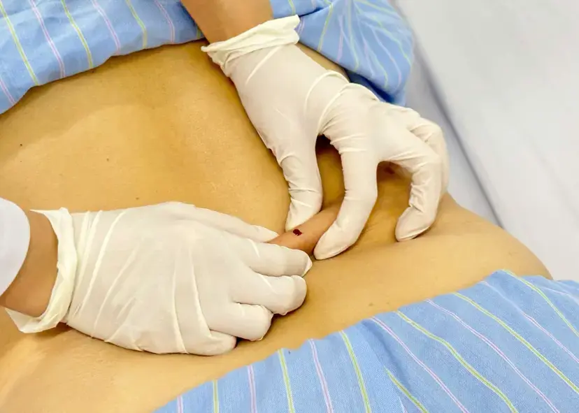 Kim tam lăng và các dụng cụ vô khuẩn cần thiết cho quá trình chích lể (nặn máu) theo nguyên tắc YHCT