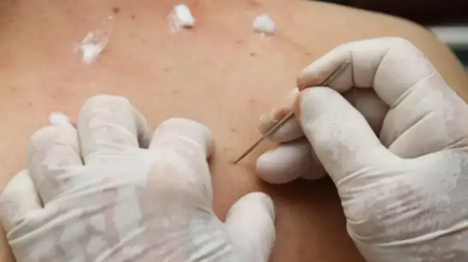 Chuyên gia YHCT thực hiện chích lể (nặn máu) an toàn để hỗ trợ các tình trạng như chắp lẹo mắt và hạ sốt